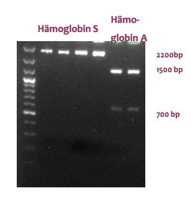 Agarose-Gelelktrophorese einer Restriktionsanalyse des HämoglobinA- bzw. HämoglobinSgens mit MstII.