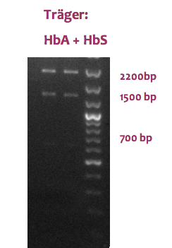 Agarose-Gelelktrophorese einer Restriktionsanalyse eines Trägers für Sichelzellanämie. Hier wird eine 'Mischung' der beiden Verdaumuster sichtbar. Alle Fragement (2200 bp, 1500bp und 700 bp) sind sichtbar. Beide Allele sind vorhanden.